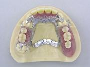 部分床義歯(自由診療)