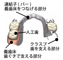 部分義歯の構造